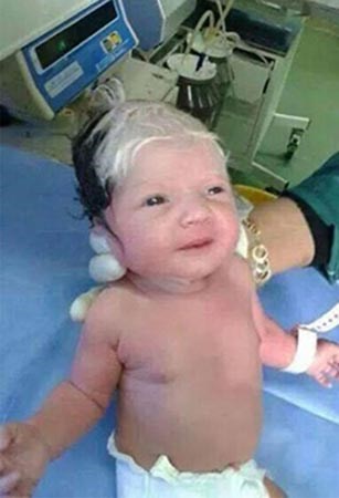 ولادة طفل سوري بشعر شايب