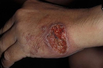 بالصور صحيفة بريطانية مرض جلدي نادر سيعجل بنهاية داعش بالصور صحيفة بريطانية مرض جلدي نادر سيعجل بنهاية داعش