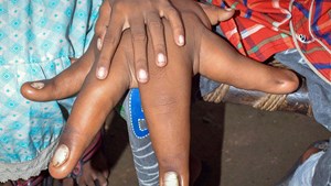 بالصور طفل يملك أضخم يدين في العالم