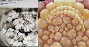 بالصورة .. شيء لا يتخيل.. مراهق في فمه 232 سِناً! 2 شيء لا يتخيل.. مراهق في فمه 232 سِناً!