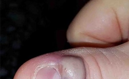 يصاب بمرض خطير بسبب إدمانه على قضم أظافره